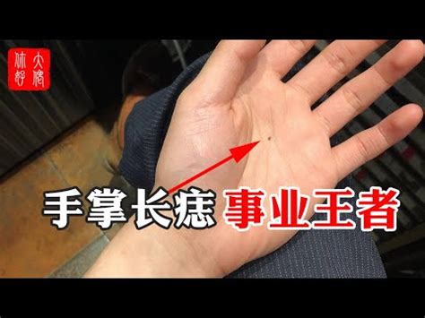 右手大拇指突然長痣|【大拇指突然長痣】驚！大拇指突然長痣，竟藏著驚人徵兆！